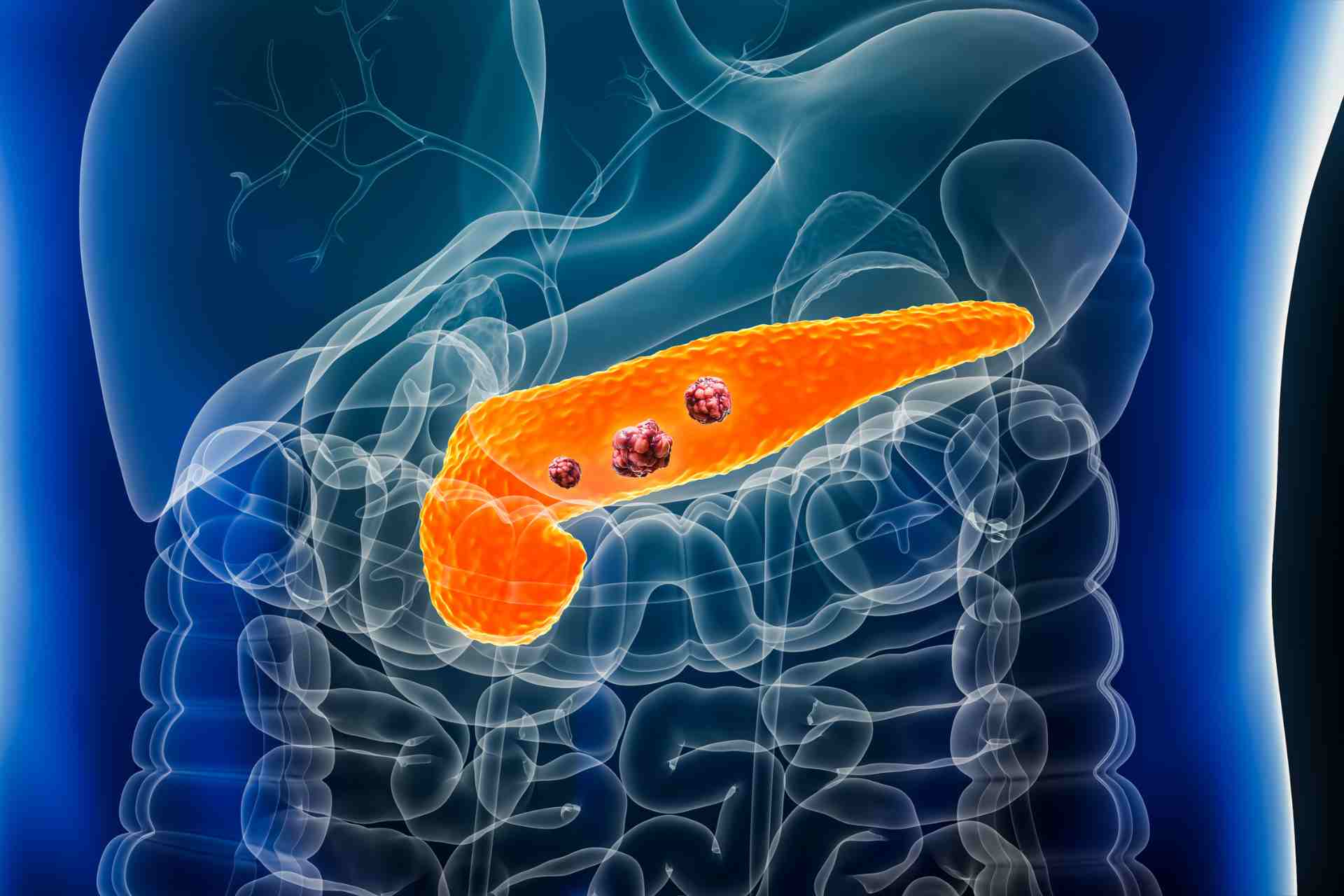 Cura del cancro al pancreas, da Genova lo studio dell'Iit per migliorare le terapie