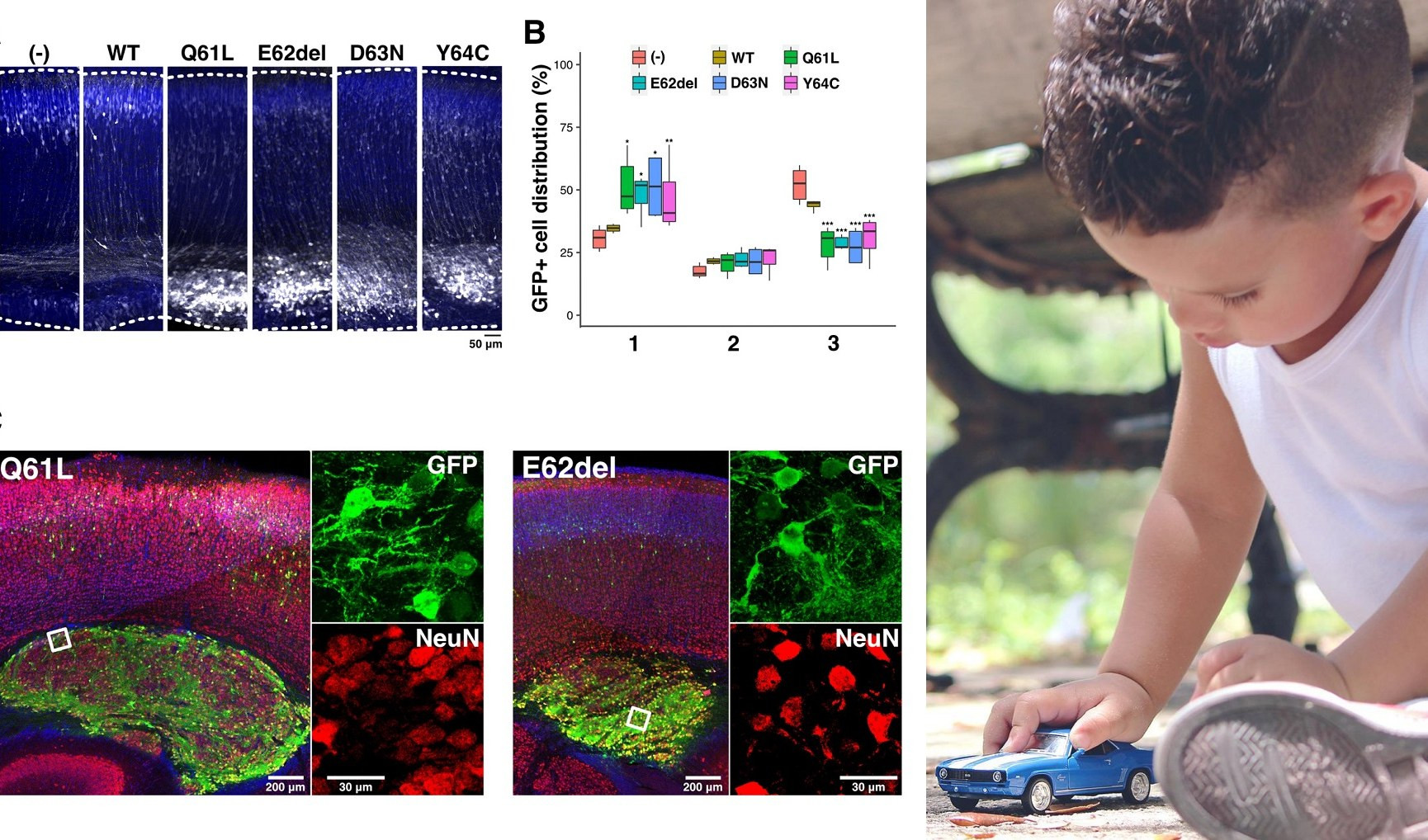 Genova Gaslini, disabilità cognitiva causata da mutazioni nel gene RAC3