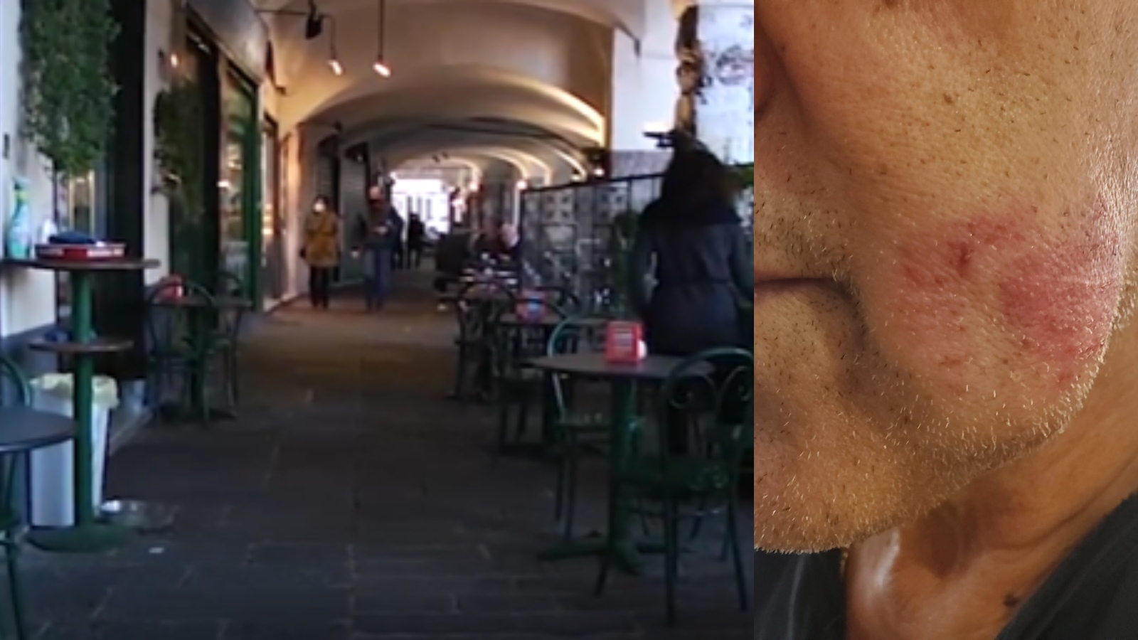 Genova: invita clochard ad allontanarsi, barista morsicato al viso