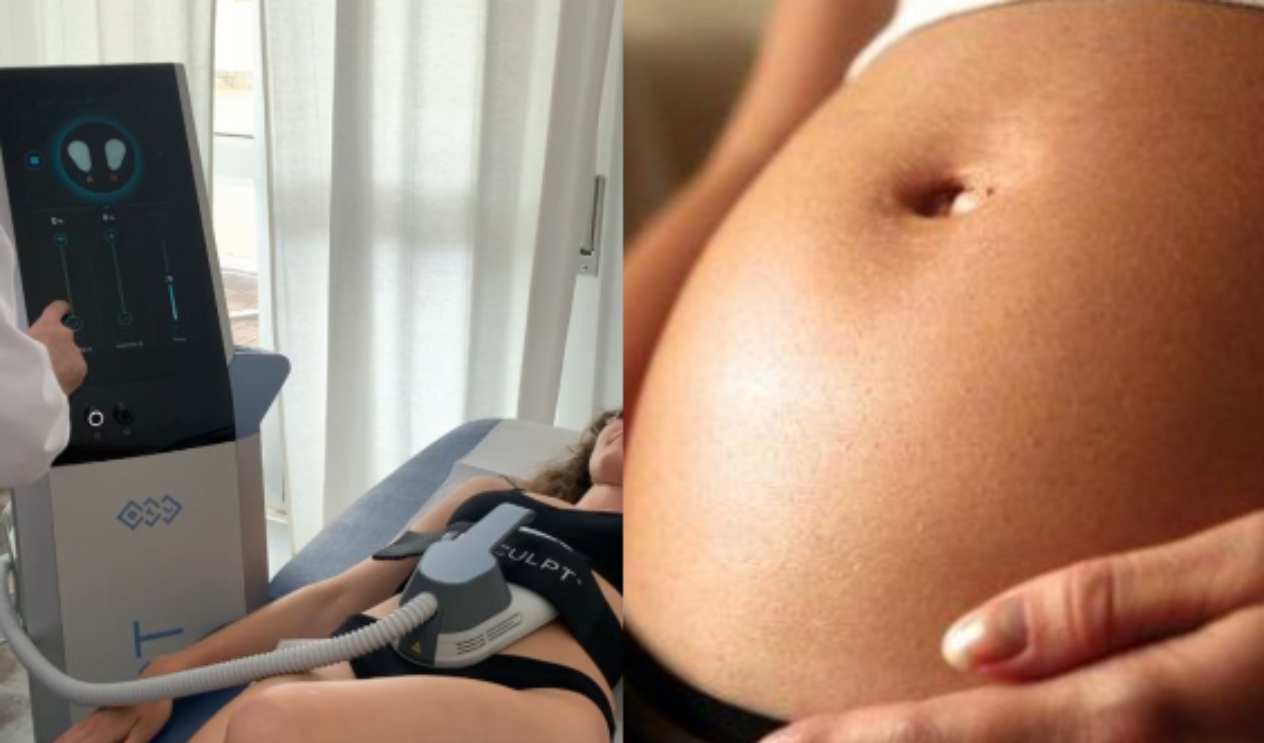 Diastasi addominale post gravidanza, 1 donna su 3 ne soffre: anche in Liguria arriva la soluzione non chirurgica 