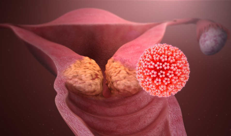 Papilloma virus, i dati: colpisce l'85% delle persone sessualmente attive