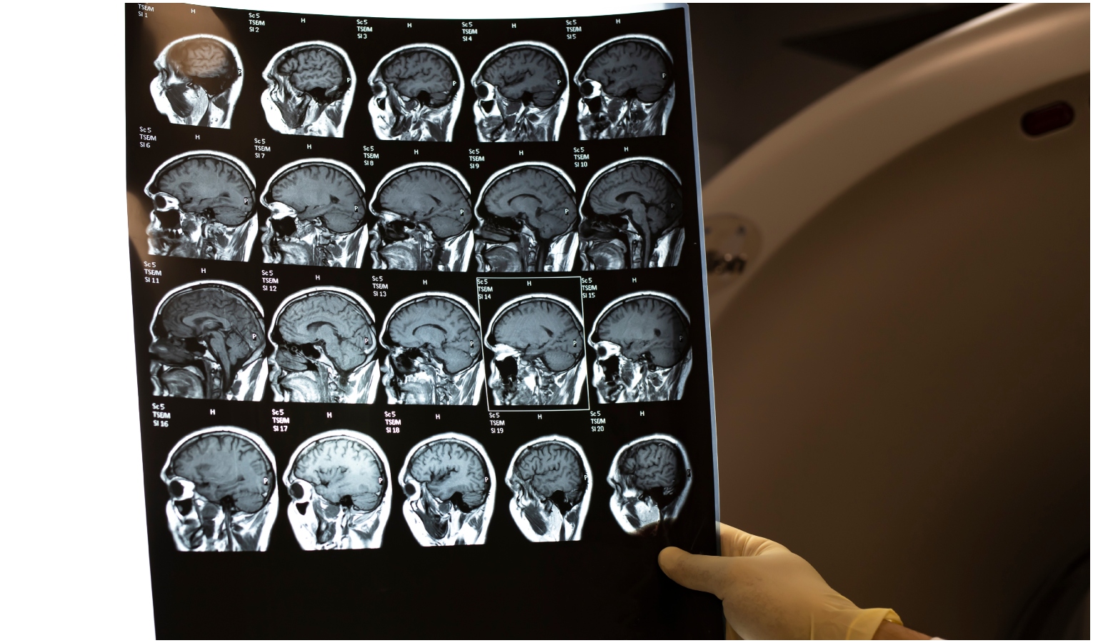 Al San Martino una nuova terapia 'su misura' per i malati di Parkinson Risonanza magnetica al cervello