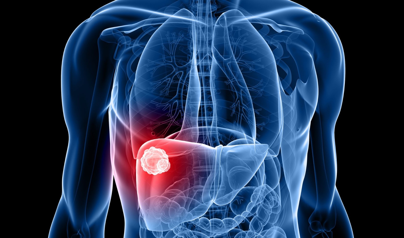 Tumore al fegato, in Liguria previsti 300 casi ogni anno